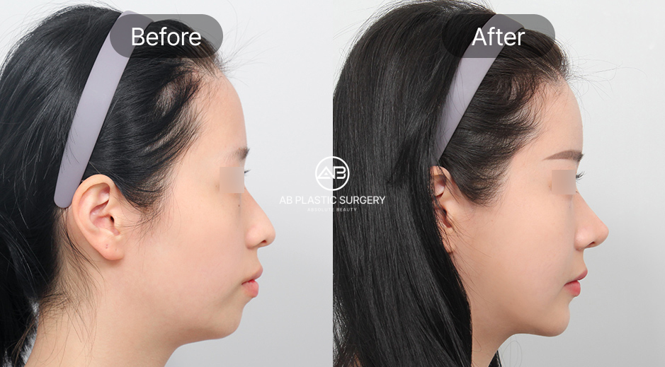 ภาพก่อนและหลังเสริมคางเกาหลีของผู้ที่มีคางร่น แก้ปัญหาคางถอยให้ยื่นออกอย่างสมดุลกับแนวใบหน้า ผลลัพธ์หลังผ่าตัดดูเป็นธรรมชาติและมีมิติมากขึ้น