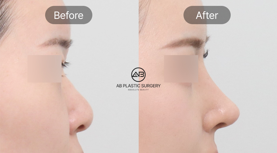 ภาพก่อนและหลังศัลยกรรมจมูกเกาหลี และคำถามที่พบบ่อย