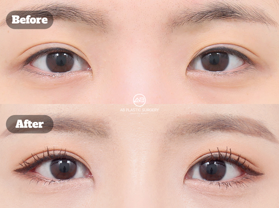 ภาพผลลัพธ์ก่อนและหลังศัลยกรรมเปิดหางตาและเปิดตาล่างในเกาหลี แสดงการเปลี่ยนแปลงรูปตาอย่างชัดเจน