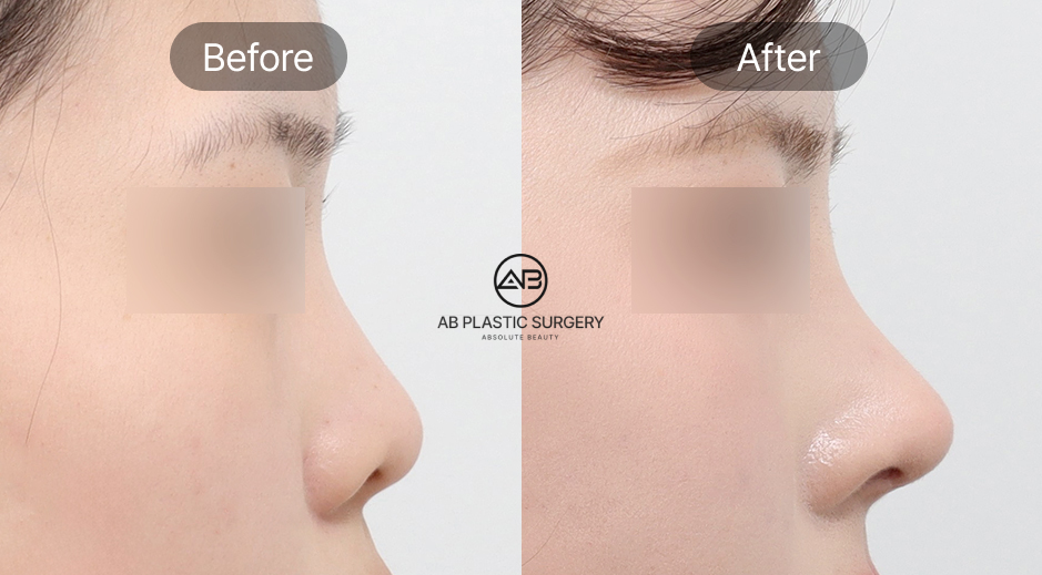 เทรนด์ศัลยกรรมจมูกเกาหลี ทรงธรรมชาติและสัดส่วนที่กำลังได้รับความนิยม