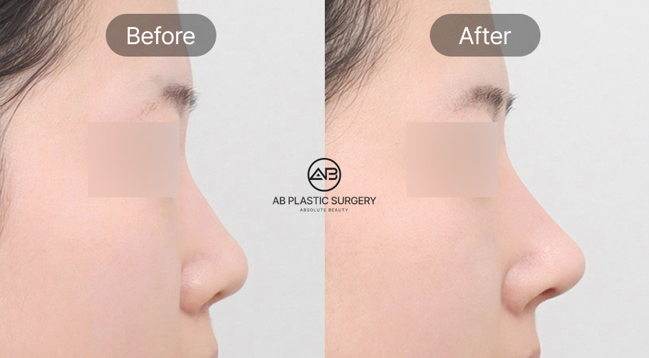 แนะนำโรงพยาบาลศัลยกรรมจมูกเกาหลี โรงพยาบาลศัลยกรรม AB ประเทศเกาหลี