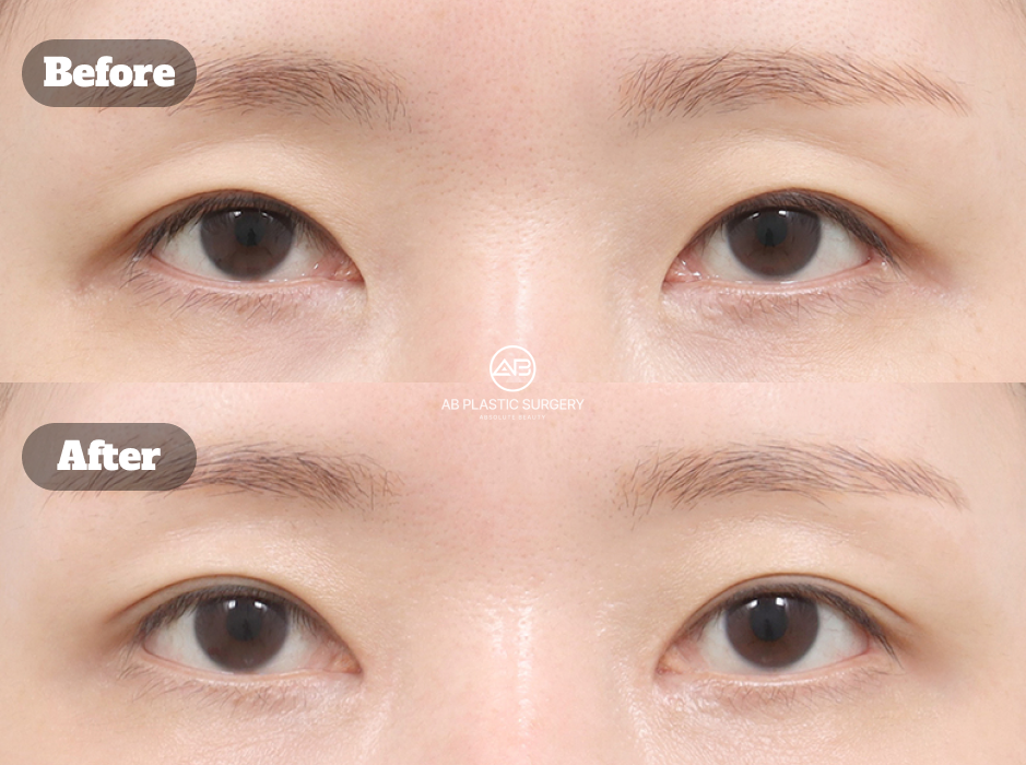 ภาพผลลัพธ์ก่อนและหลังศัลยกรรมตาในเกาหลี สำหรับการแก้ไขรูปตาแบบไม่กรีดในการผ่าตัดแก้ไขร่วมกับการเปิดหัวตา