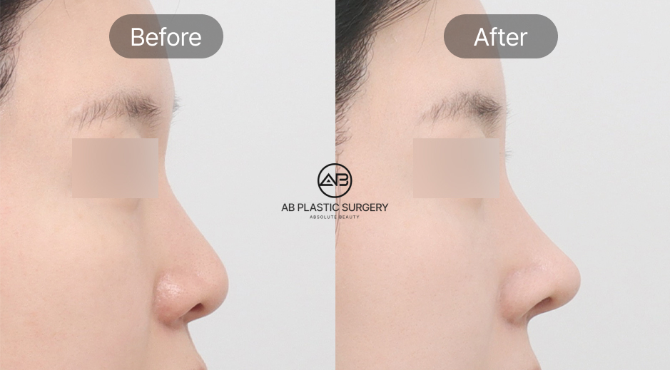 ทรงจมูกหยดน้ำแบบเกาหลี ปลายจมูกละมุนและโครงสร้างแข็งแรง